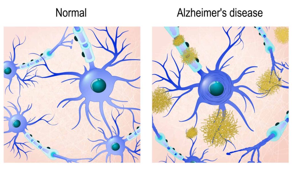 Brains with Alzheimers have abnormal protein structures